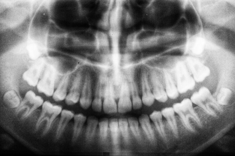 Æstetiske Plastfyldninger: Din Guide til Et Smukt Smil